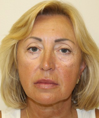 Facelift-Case--401 | Before Facelift 1