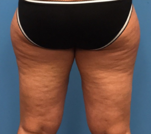 Case--278 | Before Liposuction 2