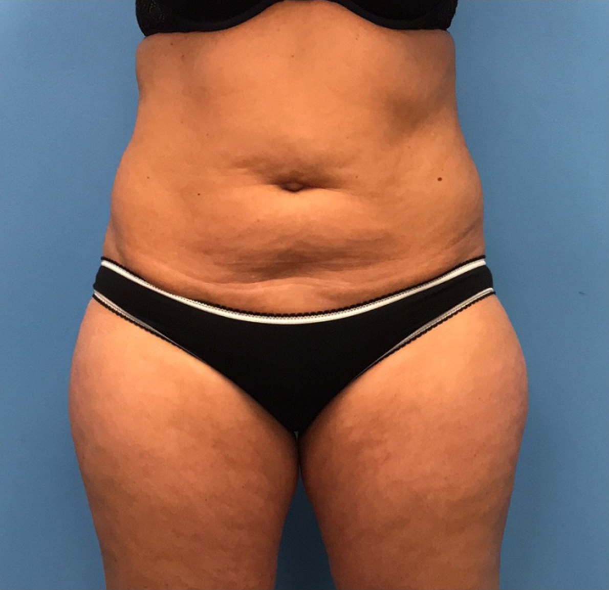 Liposuction-Case--72-1 | Before Liposuction 1