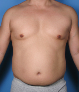 Case--389 | Before Liposuction 1