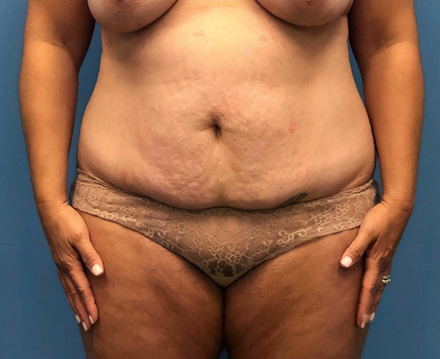 Case--252 | Before Mommy Makeover 1