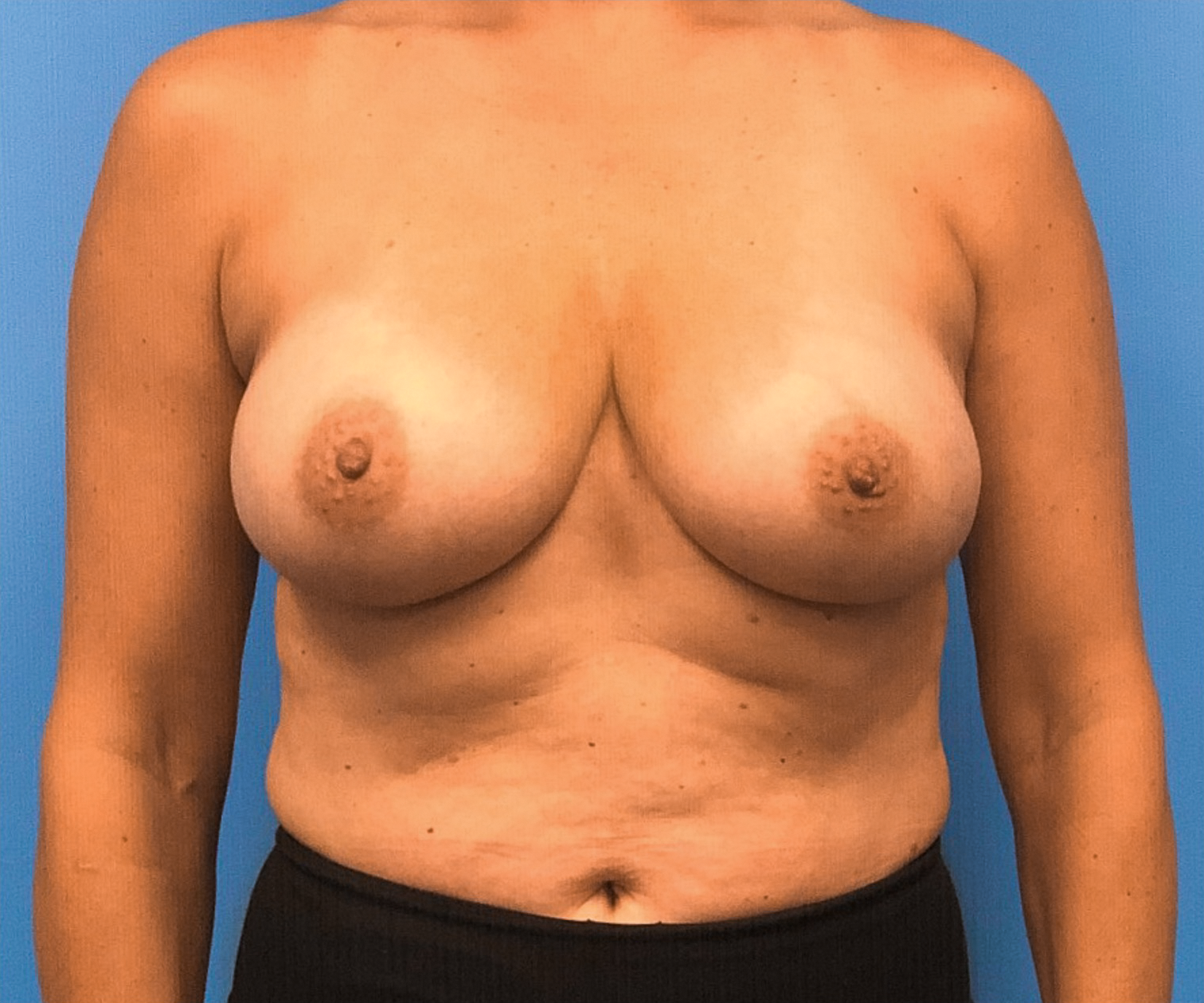 Breast-Reconstruction-Case--294 | Before Breast Reconstruction 1