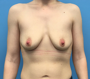 Breast-Augmentation-Case--93 | Before Dr. Frank Albino 1