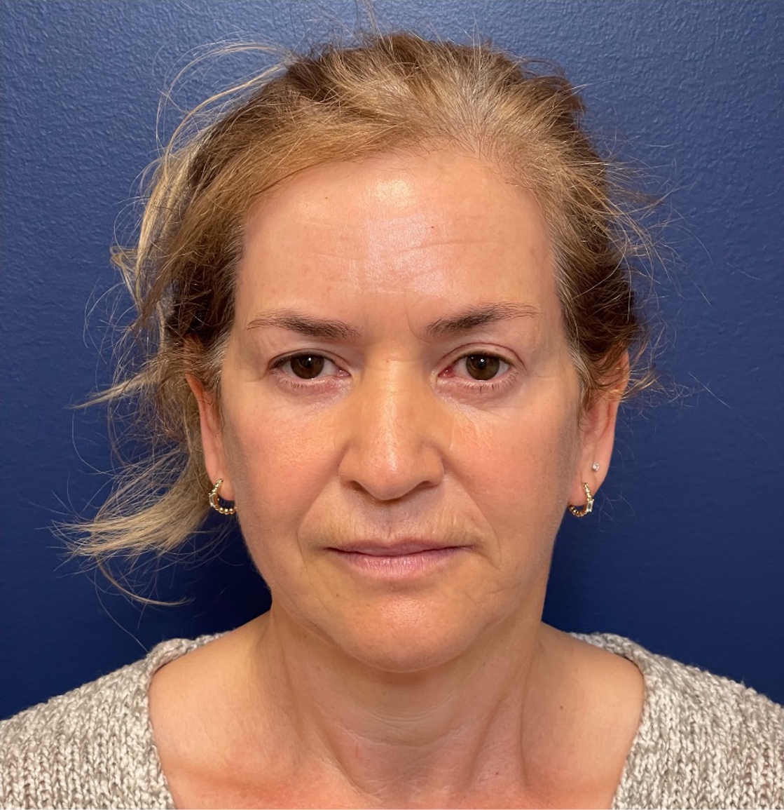 Facelift-Case--292 | Before Facelift 1