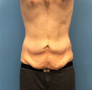 Body-Lift-Case--273 | Before Body Lift 1