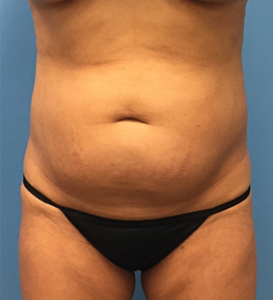 Case--65 | Before Liposuction 1