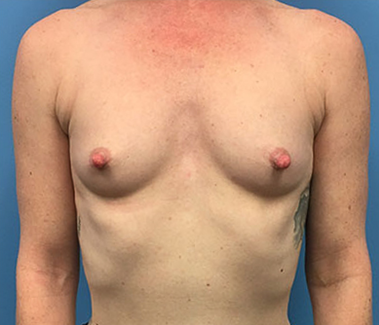 Case--88 | Before Breast Augmentation 1