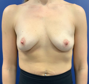 Breast-Augmentation-Case--20570 | Before Dr. Frank Albino 1