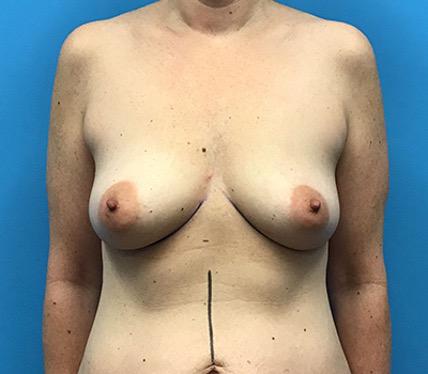 Case--96 | Before Breast Augmentation 1