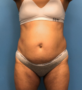 Case--14819 | Before Liposuction 1