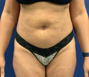 Lipoabdominoplasty-Case--21755 | Before Tummy Tuck 1