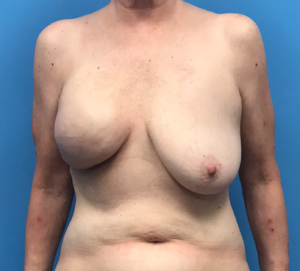 Case--10040 | Before Breast Reconstruction 1