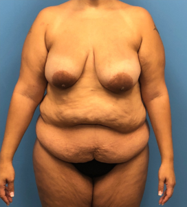 Lipoabdominoplasty-Breast-Augmentation-Case--15133 | Before Mommy Makeover 1