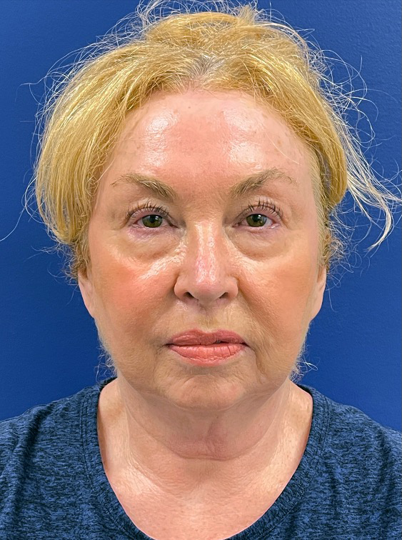 Facelift-Case--22860 | Before Facelift 1