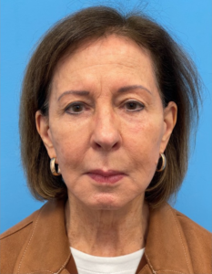 Facelift-Case--25941 | Before Facelift 1