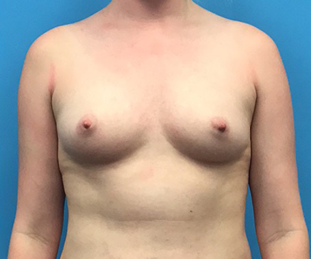 Case--94 | Before Breast Augmentation 1