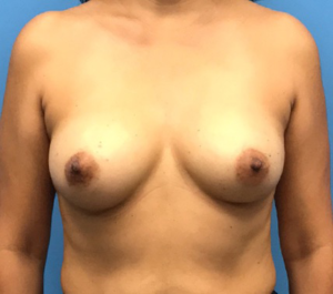 Case--134 | Before Breast Reconstruction 1