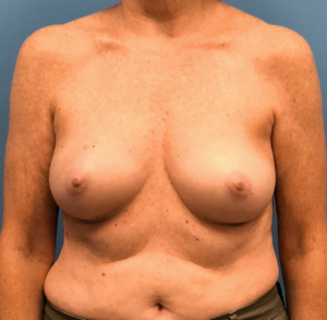 Case--13861 | Before Breast Reconstruction 1