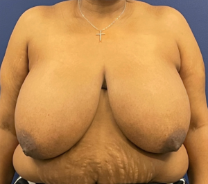 Breast-Reduction-Case--21991 | Before Breast Reduction 1