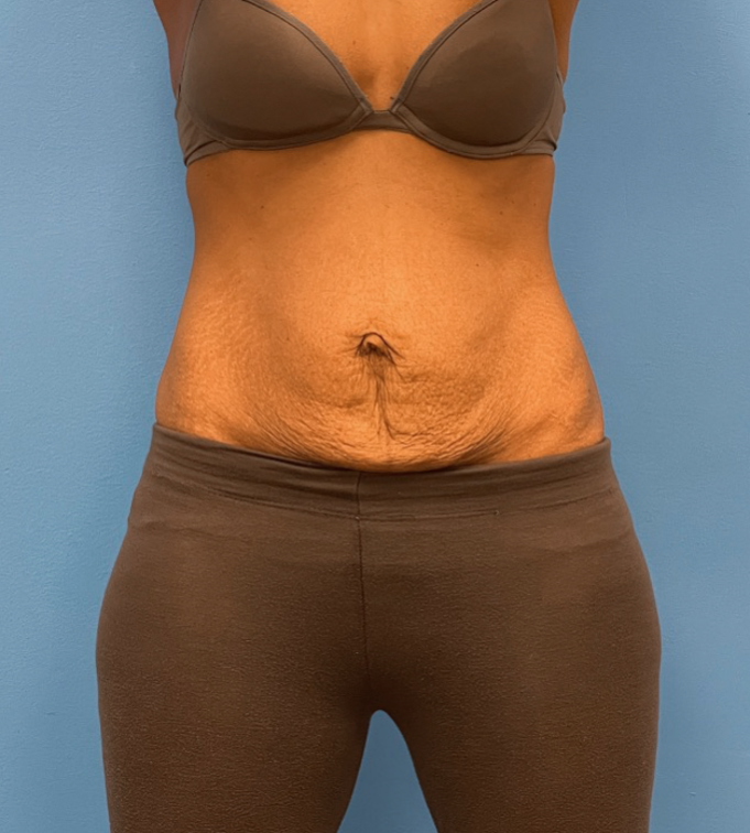 Abdominoplasty-Case--24922 | Before Liposuction 1