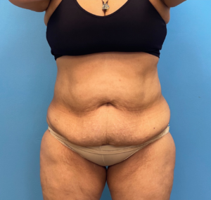 Lipoabdominoplasty-Case--27602 | Before Liposuction 1