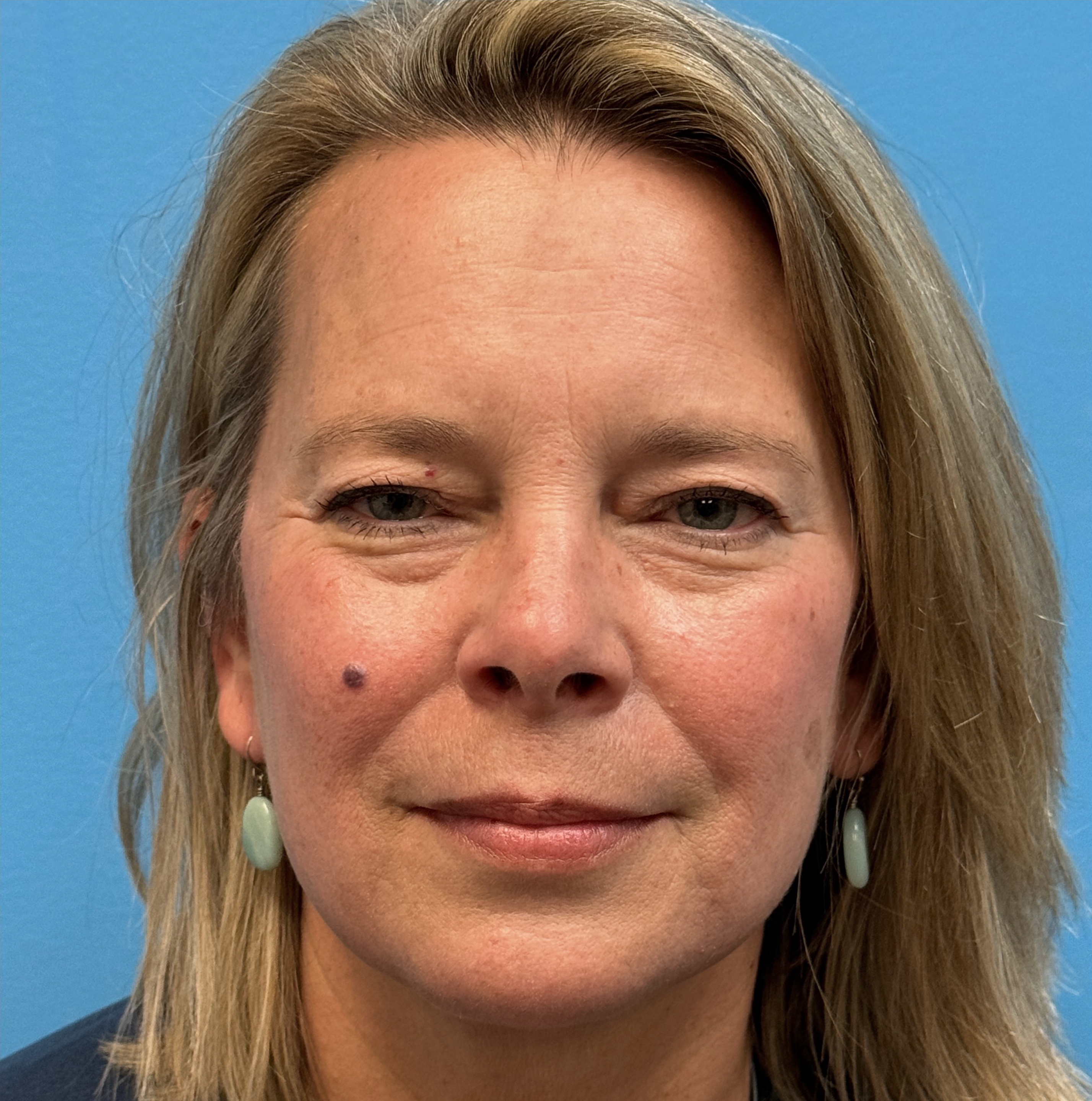 Blepharoplasty-Case--13622 | Before Eyelid Surgery 1