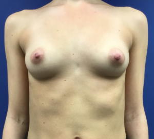 Breast-Augmentation-Case--19360 | Before Dr. Frank Albino 1