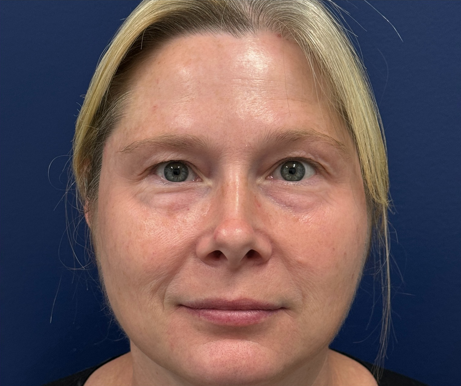 Blepharoplasty-Case--29601 | Before Eyelid Surgery 1