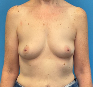 Breast-Augmentation-Case--27374 | Before Dr. Frank Albino 1
