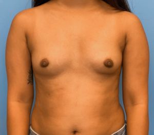 Breast-Augmentation-Case--23834 | Before Dr. Arjun Kanuri 1