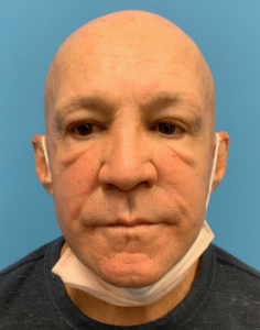 Blepharoplasty-Case--24169 | Before Dr. Arjun Kanuri 2