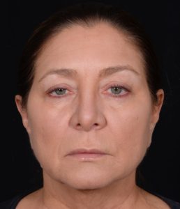 Quad-Blepharoplasty-Case--358 | Before Dr. Arjun Kanuri 1
