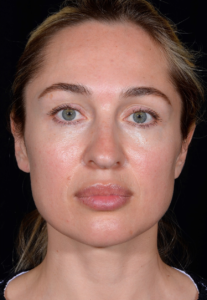 Rhinoplasty-Case--378 | Before Rhinoplasty 1