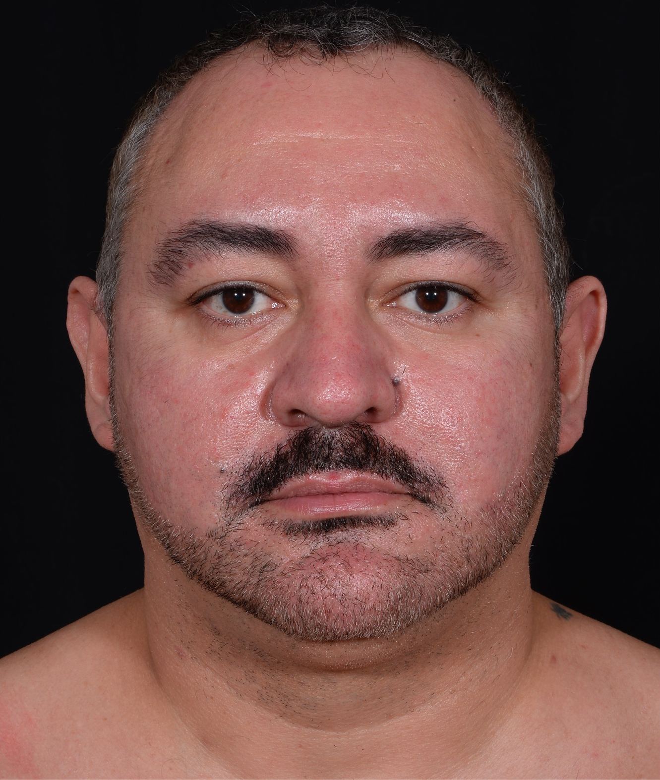 Liposuction-Case--368 | Before Liposuction 1