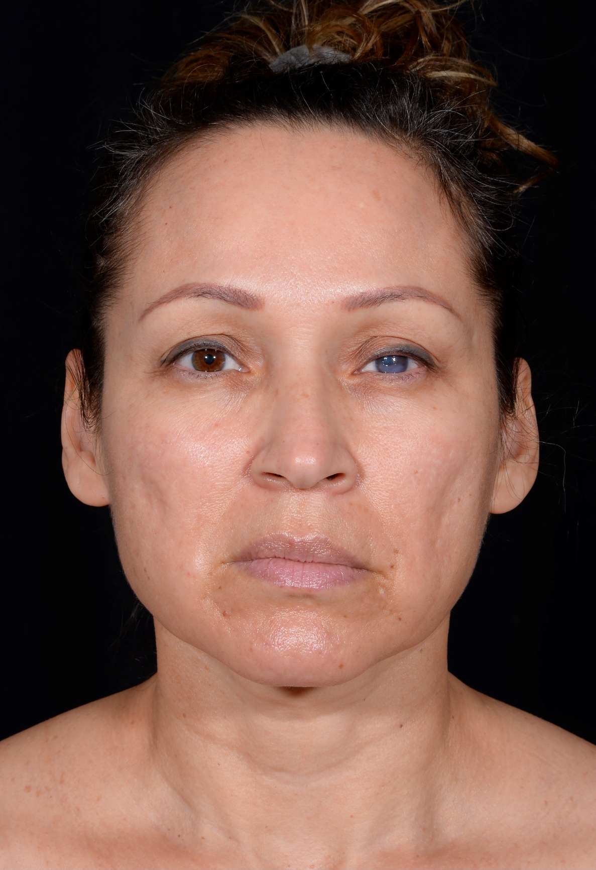 Facelift-Case--364 | Before Facelift 1