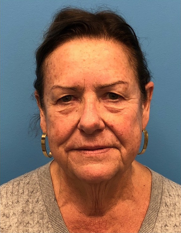 Facelift-Case--14406 | Before Facelift 1