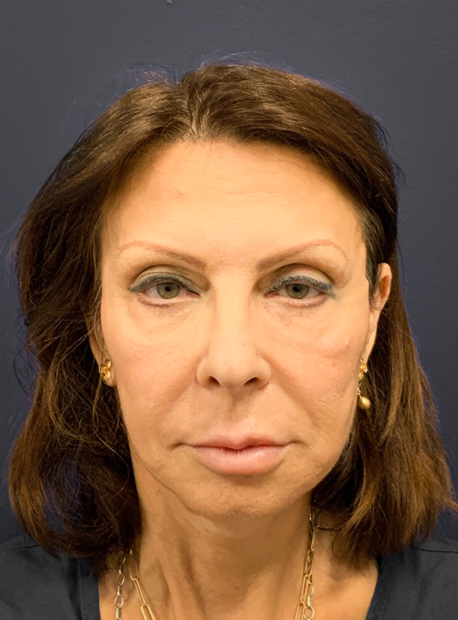 Blepharoplasty-Case--6272 | Before Eyelid Surgery 2