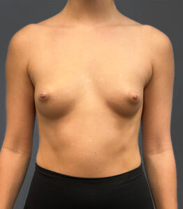 Breast-Augmentation-Case--2384 | Before Dr. Arjun Kanuri 1
