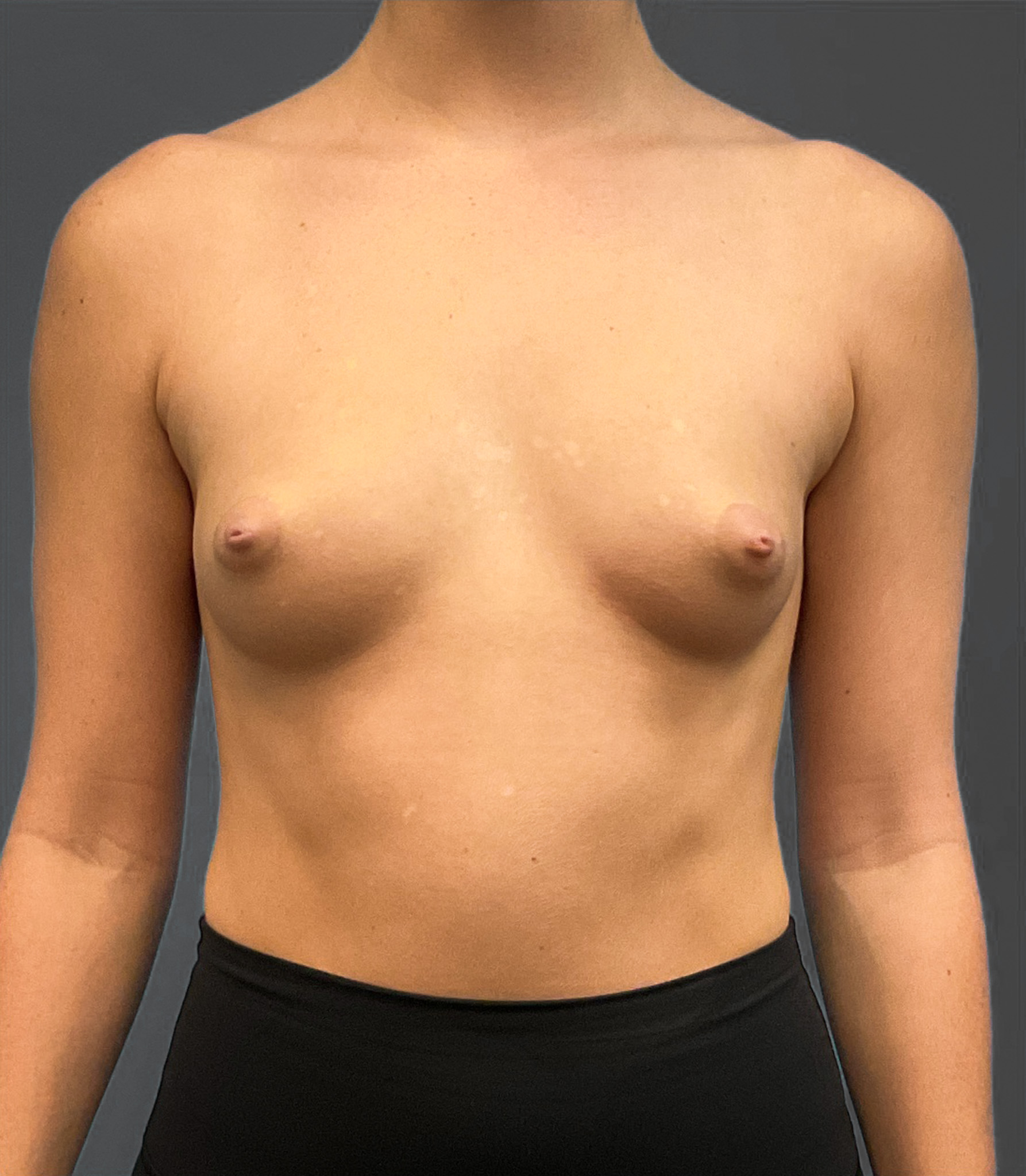 Breast-Augmentation-Case--2384 | Before Breast Augmentation 1