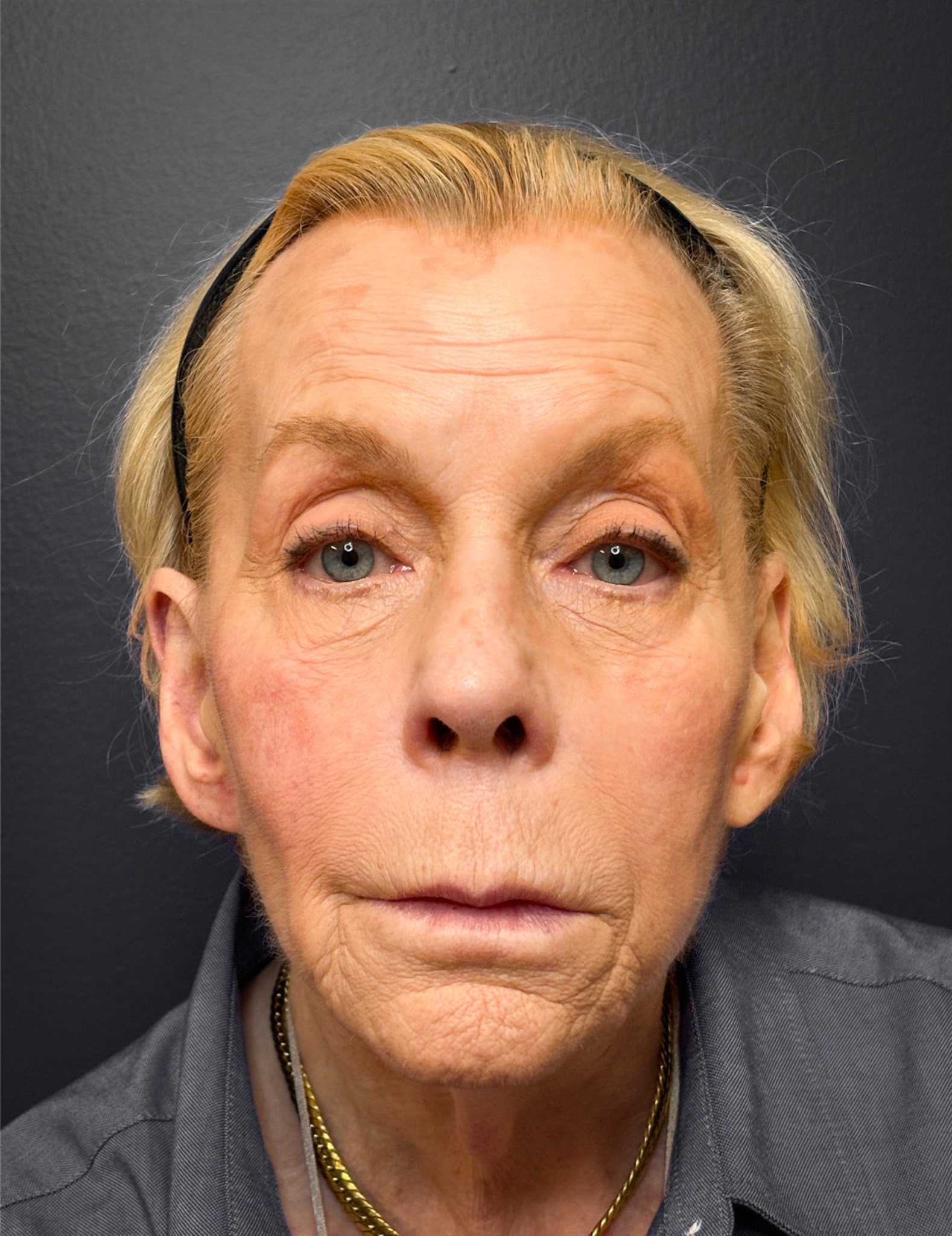 Facelift-Case--7247 | Before Facelift 1