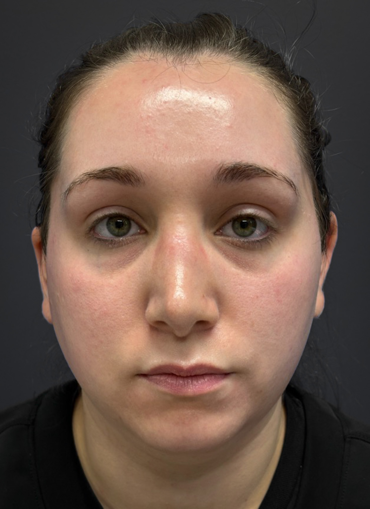 Submental-Liposuction-Case--3439 | Before Liposuction 1