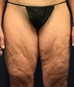 Thighplasty-Case--2024 | Before Thigh Lift 1