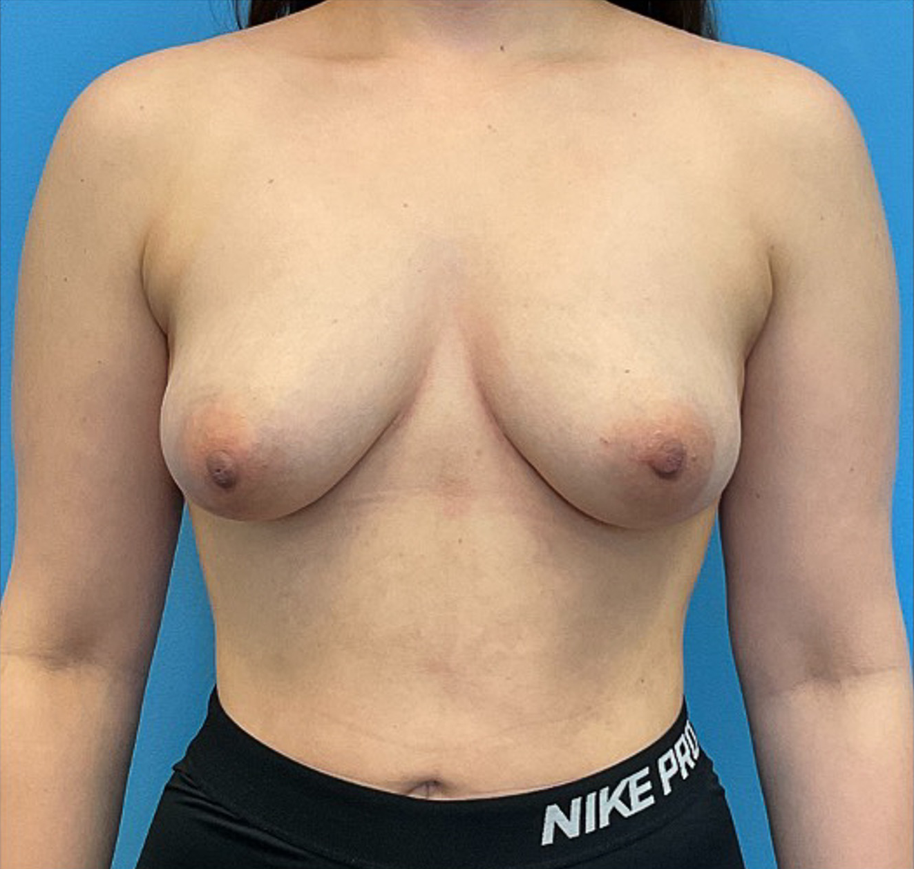 Breast-Augmentation-Case--23631 | Before Breast Augmentation 1