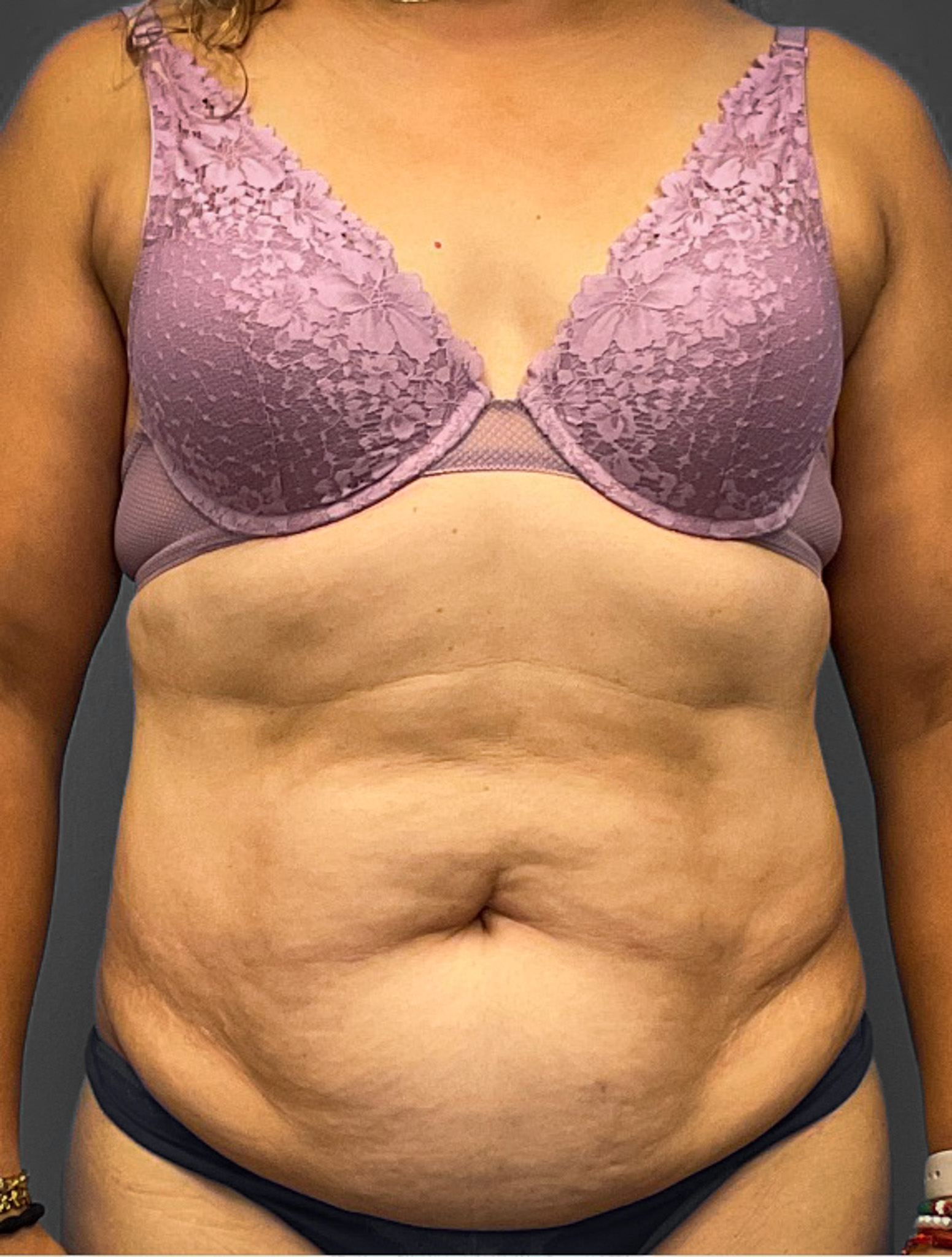 Abdominoplasty-Case--2637 | Before Tummy Tuck 1