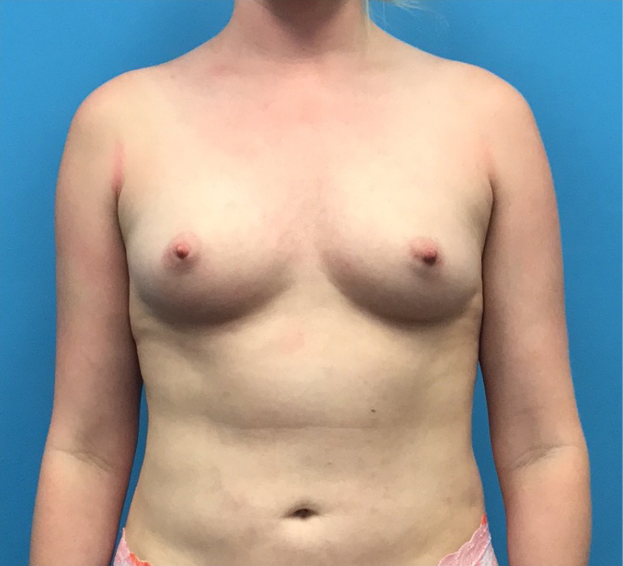 Breast-Augmentation-Case--219 | Before Breast Augmentation 1