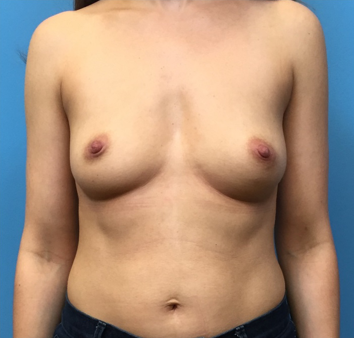 Breast-Augmentation-Case--226 | Before Breast Augmentation 1