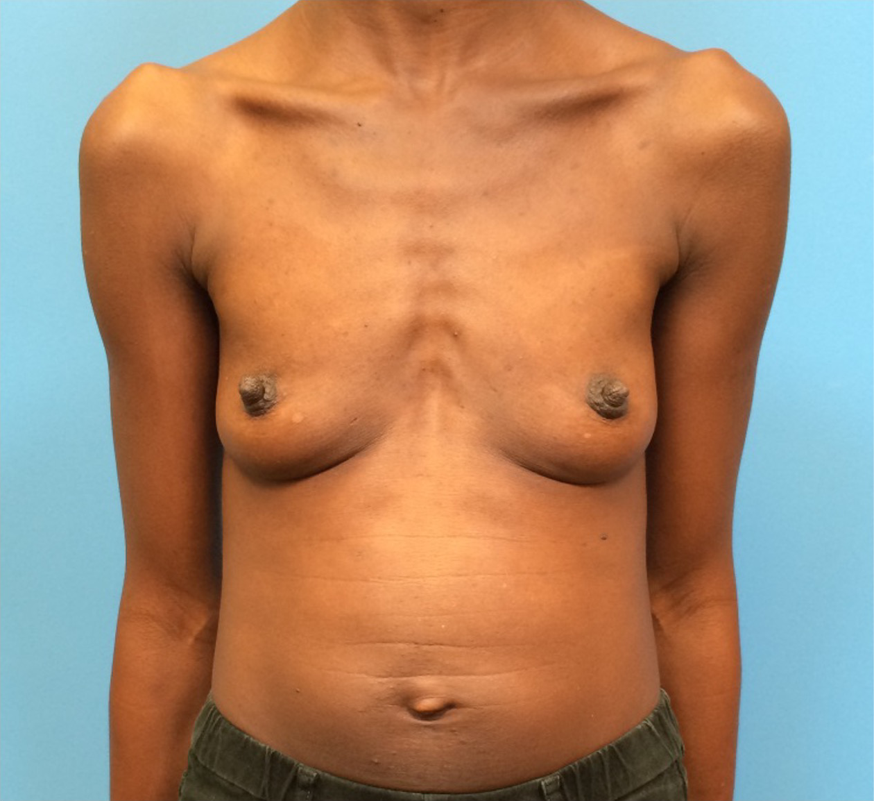 Case--97 | Before Breast Augmentation 1