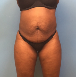 Case--246 | Before Liposuction 1