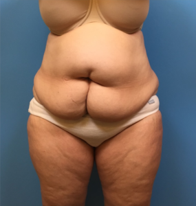 Case--249 | Before Liposuction 1