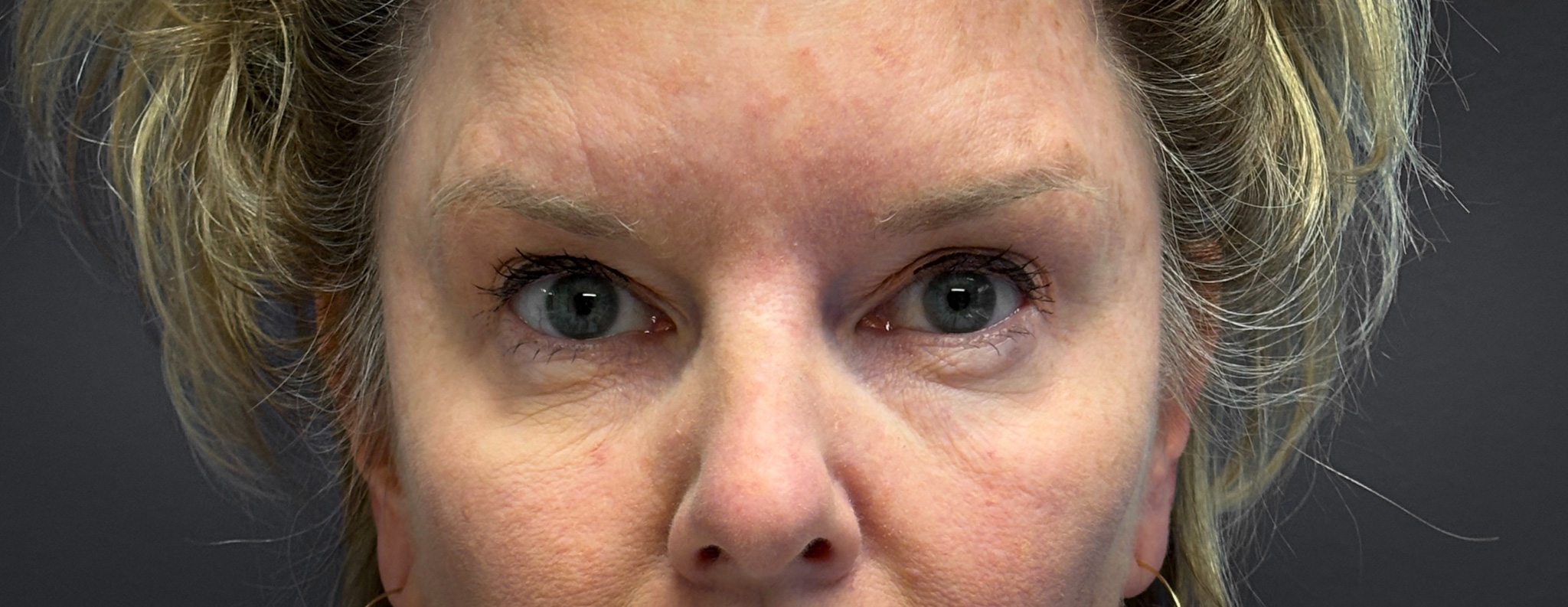 Blepharoplasty-Case--7015 | Before Eyelid Surgery 1